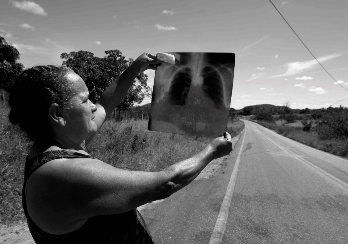 Foto: Inácio Teixeira/Coperphoto Credes Cardoso mostra o raio-X de suas placas pleurais: vítima do amianto mesmo sem ter trabalhado na mina (Foto: Inácio Teixeira/Coperphoto)