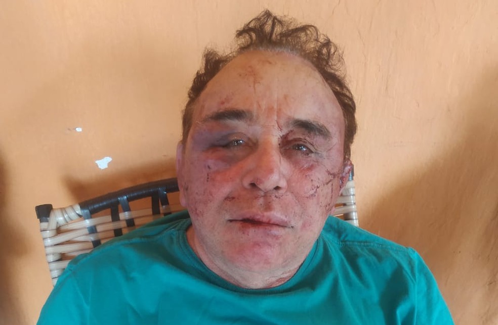 Candidato à prefeitura de Santa Teresinha, na Paraíba, José Arimateia Camboim foi atacado em sua fazenda: o agora prefeito eleito ainda se recupera da violência (Foto: Redes Sociais)