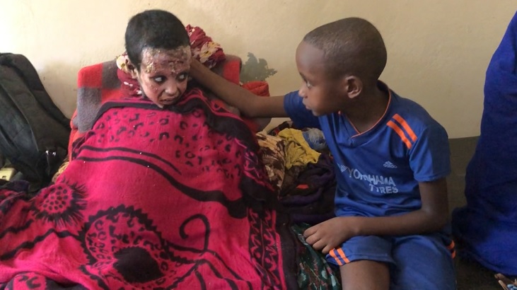 Foto Vinícius Assis Irmãos com queimaduras no corpo se consolam em um hospital na capital da Etiópia. Foto Vinícius Assis